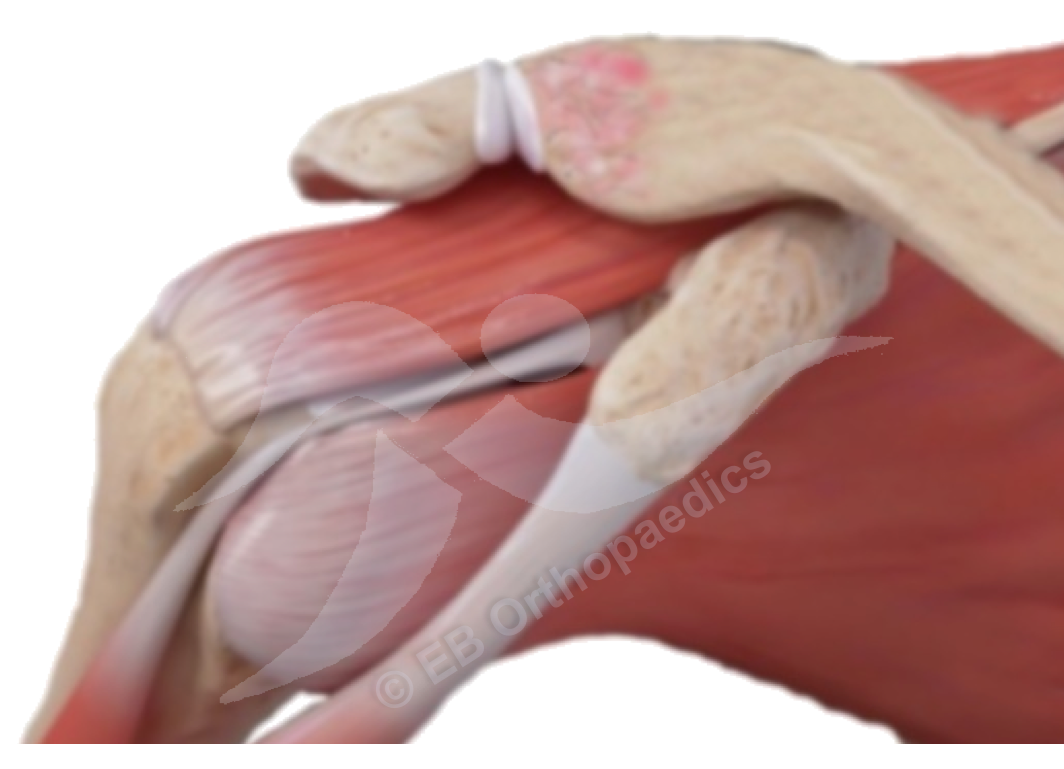 Distal clavicle osteolysis (DCO)